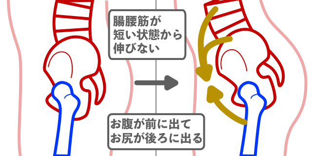 腸腰筋短縮による骨盤の前傾