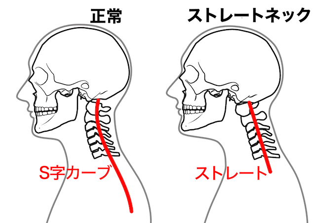 正常な頸椎の並びとストレートネックの頸椎の並びの比較